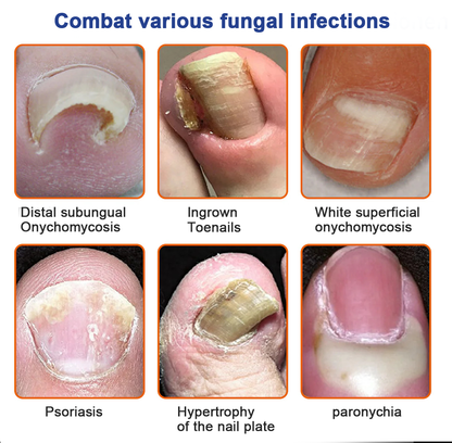 KUBOZN™ Bee Venom Nail Fungus Treatment Solution👣👣